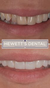 Porcelain dental veneers showing a before and after smile transformation at Hewett's Dental, professionals in Brighouse, Huddersfield, Halifax, and Bradford.