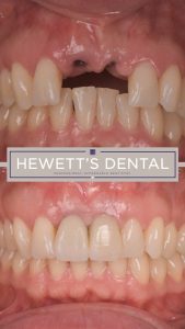 Missing teeth and dental repair, showing before and after images of dental treatment at Hewett's Dental, Brighouse, Huddersfield, Halifax, Bradford.